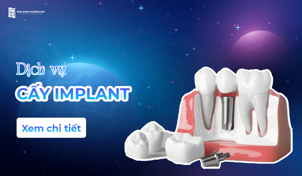 Hình ảnh minh họa dịch vụ cấy implant