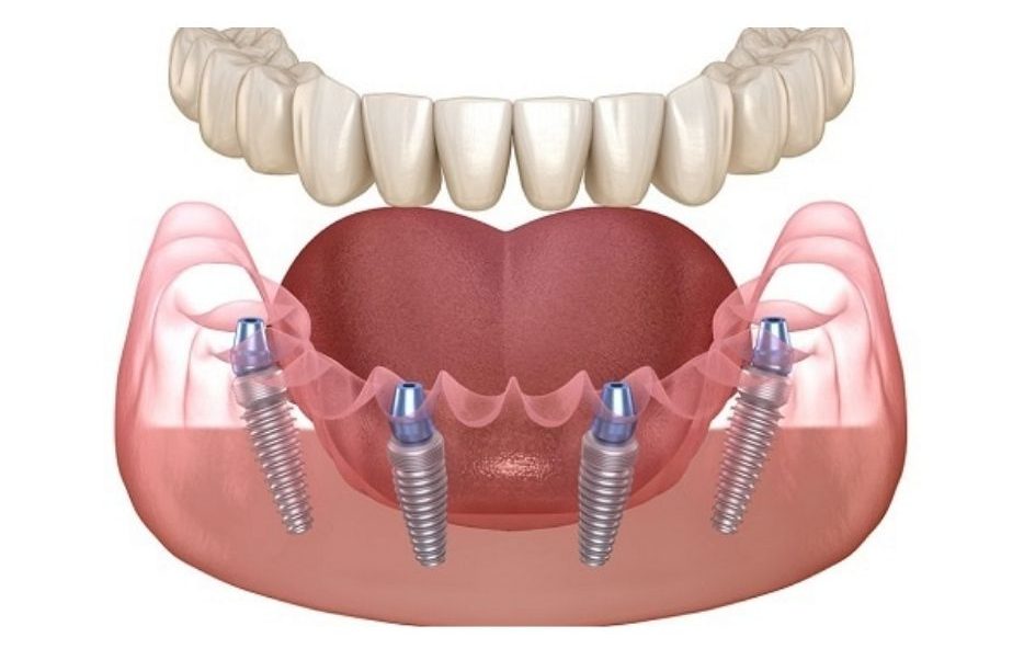 mô hình implant toàn hàm all-on-4