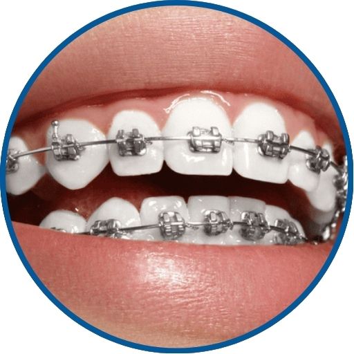 gia-mac-cai-kim-loai