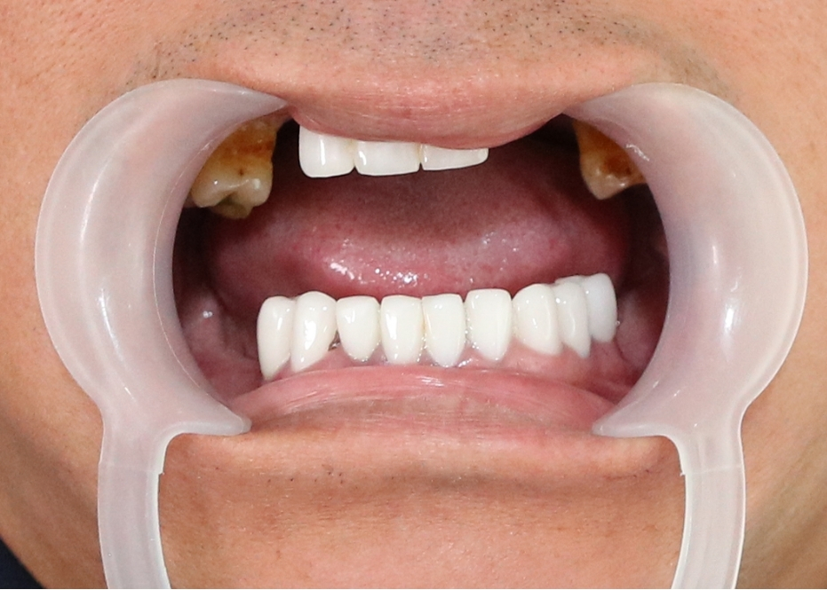 hình trước khi implant toàn hàm