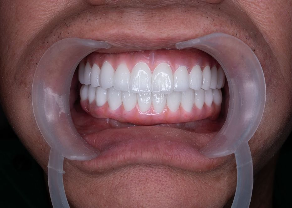 hình sau khi implant toàn hàm