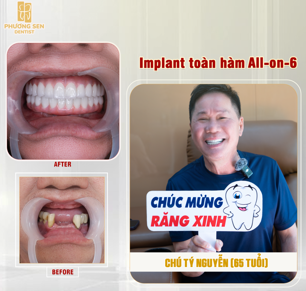 before-after-chu-ty