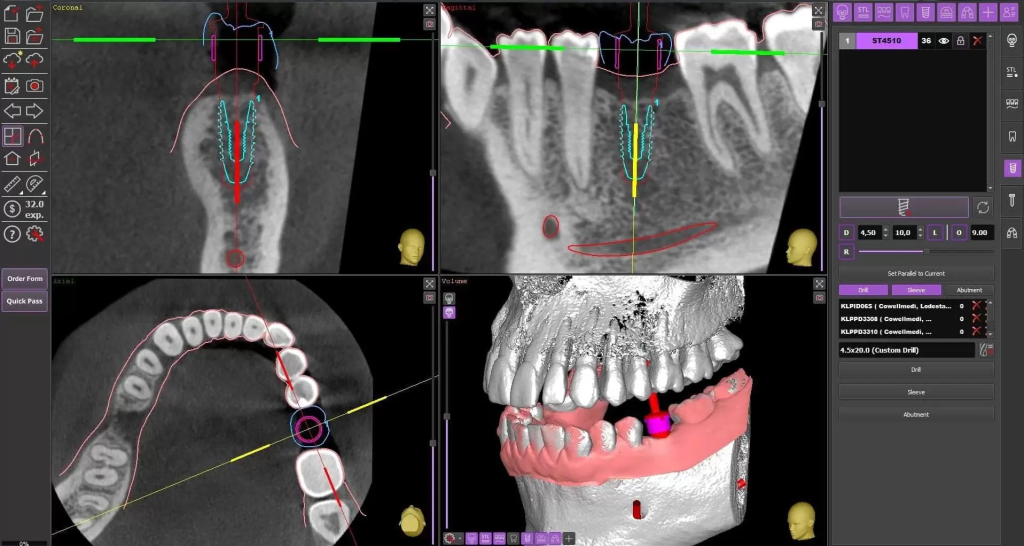 Máng-hướng-dẫn-phẫu-thuật-cấy-ghép-implant