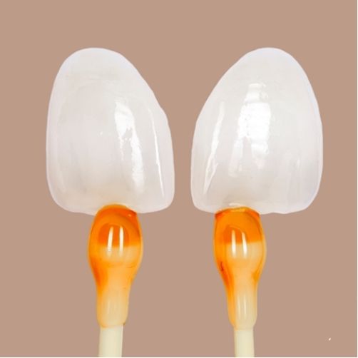 dán sứ veneer lisi