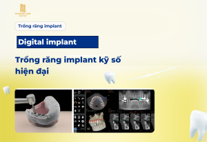 Read more about the article Digital implant – Trồng răng implant kỹ số hiện đại
